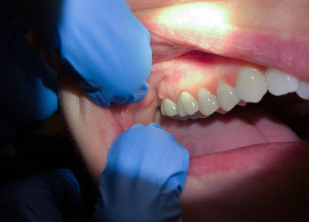 Best Emergency Root Canal Therapy in Breaux Bridge, LA